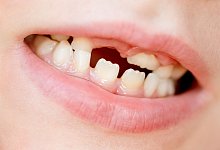 Zahnverlust - Foto: Johann Peter Kierzkowski