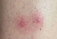 Affenpocken verursachen solche Hautsymptome. - Institute of Tropical Medicine, Antwerp/dpa