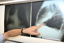 Lungenkrebs - Felix Hörhager/dpa