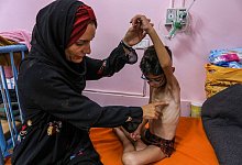 Nahost-Konflikt - Unterernährte palästinensische Kinder - Abed Rahim Khatib/dpa