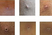 Affenpocken - Foto: UKHSA/dpa