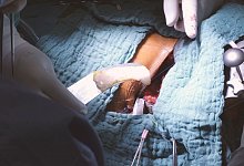 Herzpflaster aus Stammzellen - Universit&auml;tskrankenhaus Schleswig-Holstein/dpa