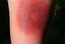 Zeckenbiss - Foto: Harry Melchert/dpa