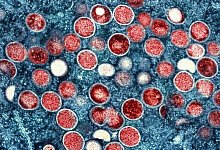 Mpox - -/National Institute of Allergy and Infectious Diseases/dpa