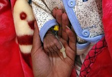 Unterern&auml;hrung im Jemen - Foto: Mohammed Mohammed/XinHua/dpa