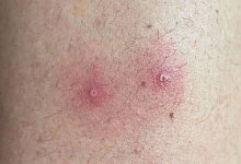 Das vom Institute of Tropical Medicine Antwerp zur Verfügung gestellte Foto zeigt Hautsymptome von Affenpocken-Patienten. - -/Institute of Tropical Medicine, Antwerp/dpa