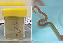 Spulwurm - Emerging Infectious Diseases/AAP/dpa