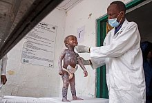 Ein Arzt in Mogadischu tr&auml;gt Hautcreme auf ein Kind auf, das Symptome von Kwashiorkor zeigt, einer schweren Eiwei&szlig;unterern&auml;hrung, die Schwellungen und Hautl&auml;sionen verursacht. - Farah Abdi Warsameh/AP/dpa