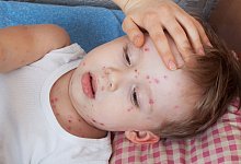 bild-1-windpocken-1 - Foto: AOK