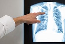 Tuberkulose - Silas Stein/dpa