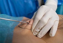 Ein plastischer Chirurg führt eine Fettabsaugung durch - Uwe Anspach/dpa-tmn