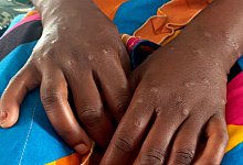 Mpox - Janvier Barhahiga/AP/dpa