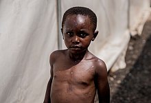 Mpox-Notfallausschuss tagt - Moses Sawasawa/AP/dpa