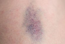 Ein Bluterguss auf einem Knie - Andrea Warnecke/dpa-tmn