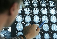 Arzt beurteilt Gehirnquerschnitte einer Schlaganfall-Patientin - Friso Gentsch/dpa/dpa-tmn