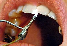 Z&auml;hne - Foto: Achim Scheidemann