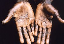 Affenpocken - Foto: -/CDC/Brian W.J. Mahy/dpa/Archiv