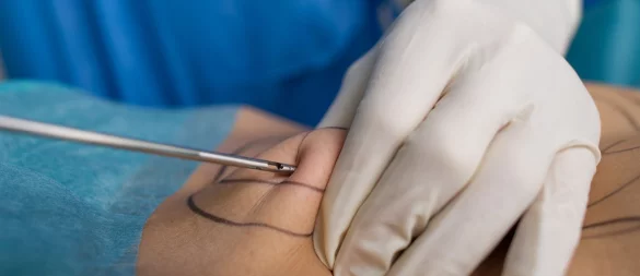 Unter bestimmten Voraussetzungen trägt die gesetzliche Krankenversicherung künftig die Kosten für eine Liposuktion. - © Uwe Anspach/dpa-tmn