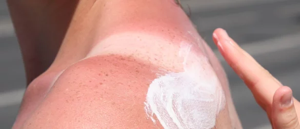 Bei Sonnenbrand ist Hautpflege gefragt: Feuchtigkeitsspendende Lotionen mit Aloe vera helfen der geschädigten Haut. - © Stephanie Pilick/dpa/dpa-tmn