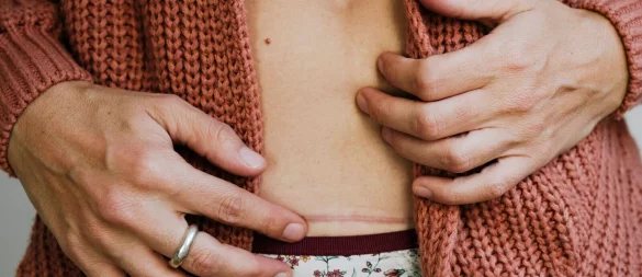 Sanfte Massagen und wenig Spannung: Das tut frischen Narben gut. - © Gemma Ferrando/Westend61/dpa-tmn