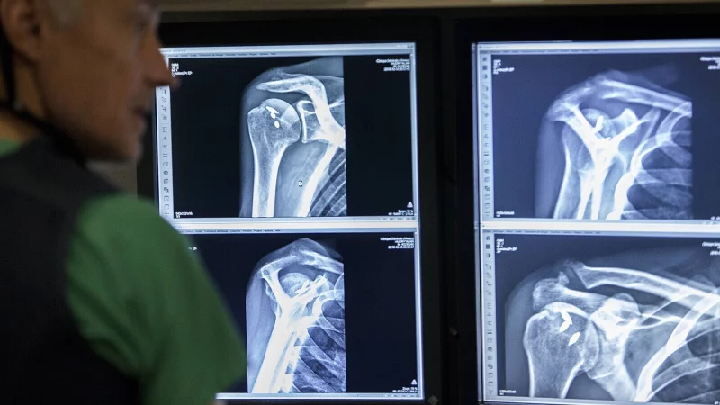 Osteoporose erhöht das Risiko für Knochenbrüche massiv. - © picture alliance / BSIP