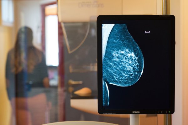 Mammographie: Die gesunde Brust einer Frau ist auf einer Röntgenaufnahme zu sehen. - © Klaus-Dietmar Gabbert/dpa-Zentralbild/dpa-tmn