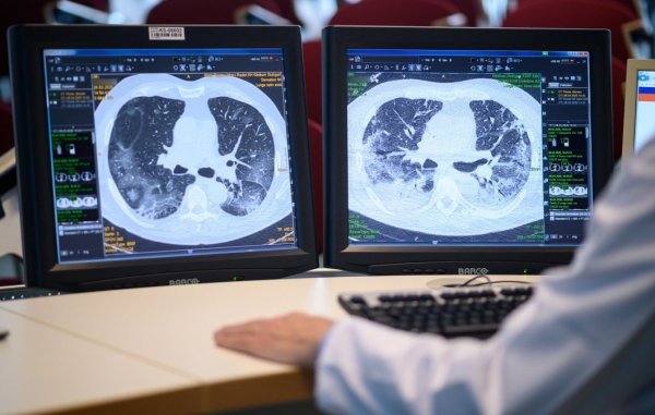 Mit Hilfe von Lungen-Aufnahmen erkrankter Covid-19-Patienten forschen Radiologen an besseren Behandlungsmethoden und den Langzeitfolgen. - © Picture Alliance