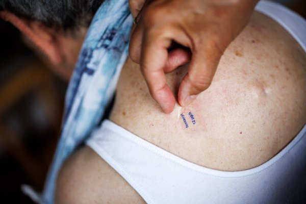 Eine Pflegekraft klebt einer Frau ein Fentanylpflaster mit der Aufschrift Fentanyl 12 Mikrogramm pro Stunde auf den Rücken. Experten kritisieren, dass die meisten Patienten diese Pflaster nicht benötigen. - © picture alliance / dpa