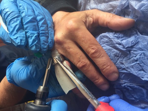 Gebrochener Finger wird einem Salzufler zum Verhängnis. - © Feuerwehr Bad Salzuflen