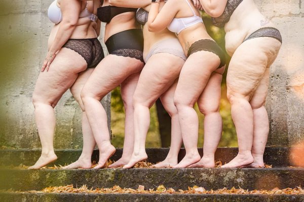 Frauen mit Lipödem-Erkrankung. Betroffene kämpfen für eine Ent-Stigmatisierung der Krankheit und fordern mehr kompetente Ärzte. - © Carina Gorny Fotografie/Lipödem-Gesellschaft/dpa