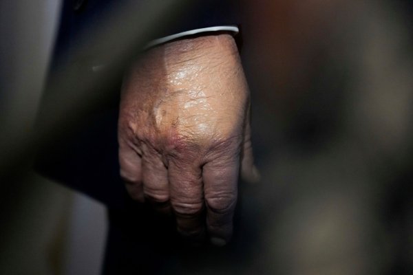 Nachdem der Bluterguss am Handrücken für Aufsehen sorgte, wurde er häufig bei Auftritten zugeschminkt. (Archivbild) - © Julia Demaree Nikhinson/AP/dpa