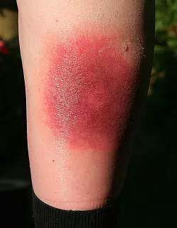 Klares Warnzeichen für Borreliose: Die sogenannte Wanderröte kann Tage oder Wochen nach einem Zeckenstich auftreten. (Archivbild) - © Harry Melchert/dpa/dpa-tmn