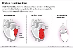 Das Broken-Heart-Syndrom erinnert an einen Herzinfarkt. Tatsächlich verändert sich dabei aber vor allem die linke Herzkammer. - © dpa-infografik/dpa-tmn
