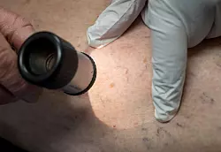 Ein Arzt untersucht in der Praxis die Hautpartie eines Patienten. (Archivbild) - &copy; Peter Kneffel/dpa