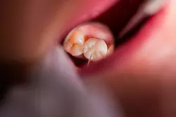 Zahnschmerzen vermiesen das Fest? Dann ist der zahn&auml;rztliche Notdienst die passende Anlaufstelle. - &copy; Rolf Vennenbernd/dpa/dpa-tmn