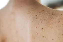 Hautkrebs ist einer der häufigsten Krebserkrankungen in Deutschland. - © Christian Charisius/dpa