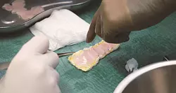 Das «Herzpflaster» wird aus mehreren Teilen zusammengesetzt. - © ---/Universitätskrankenhaus Schleswig-Holstein/dpa