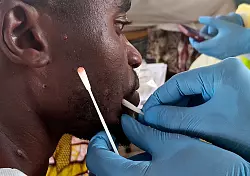 Anders als die Pocken lassen sich Mpox nicht ganz ausrotten. (Archivbild) - © Janvier Barhahiga/AP/dpa