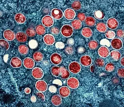 Überlässt die Welt die Zukunft von Mpox der Natur und dem Zufall? (Archivbild) - © -/National Institute of Allergy and Infectious Diseases/dpa
