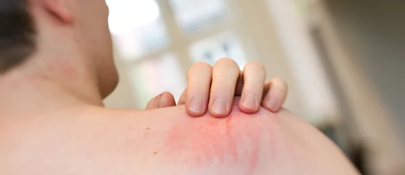 Die Zahl der Krätze-Fälle in Westfalen-Lippe steigt an. Das geht aus einer Auswertung der AOK Nordwest unter ihren Versicherten hervor. - © picture alliance / dpa