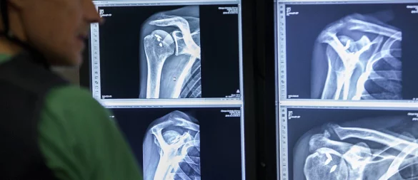 Osteoporose erhöht das Risiko für Knochenbrüche massiv. - © picture alliance / BSIP