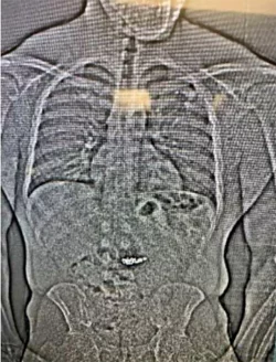 Beweisfindung per Röntgenbild. - © Uncredited/Orlando District Attorney\\\'s office/AP/dpa