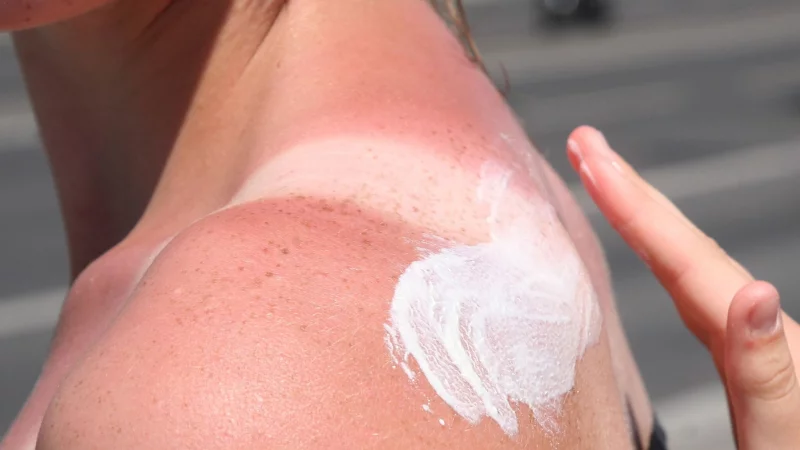 Bei Sonnenbrand ist Hautpflege gefragt: Feuchtigkeitsspendende Lotionen mit Aloe vera helfen der geschädigten Haut. - © Stephanie Pilick/dpa/dpa-tmn