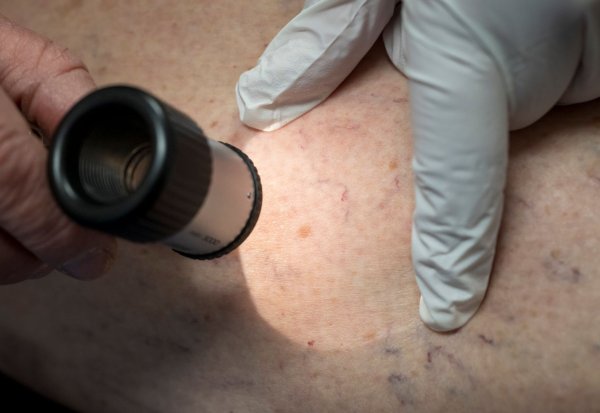 Die Zahl der Krankenhausbehandlungen von Hautkrebs stieg enorm an. (Symbolbild) - © Peter Kneffel/dpa