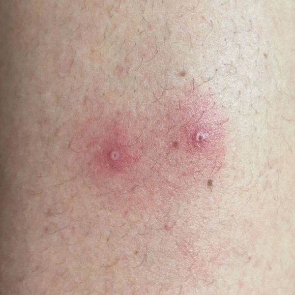 - © -/Institute of Tropical Medicine, Antwerp/dpa