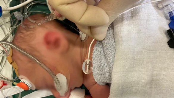 Um herzkranke Neugeborene zu versorgen, ben&ouml;tigen die &Auml;rzte sehr filigrane Ballonkatheter. Viele dieser Produkte sind in der EU aber nicht mehr verf&uuml;gbar. - &copy; HDZ NRW