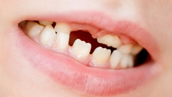 Zahnverlust - &copy; Foto: Johann Peter Kierzkowski