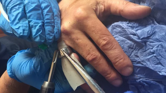 Gebrochener Finger wird einem Salzufler zum Verh&auml;ngnis. - &copy; Feuerwehr Bad Salzuflen