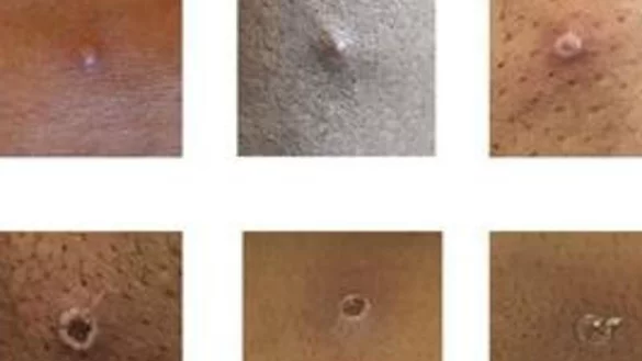 Affenpocken - &copy; Foto: UKHSA/dpa