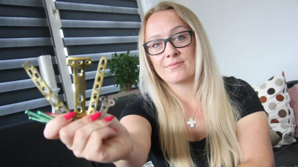 Steffi Jonas (34) mit den Metallplatten und Schrauben, die sie im Bein hatte. Ihr rechter Unterschenkel war abgetrennt, das Knie total zerst&ouml;rt. - &copy; Anne Neul